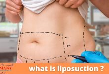 Photo of What is Liposuction?
