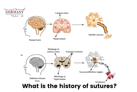 Alzheimer galopante síntomas