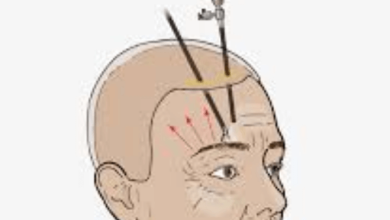 Photo of Endoscopic Forehead Lift